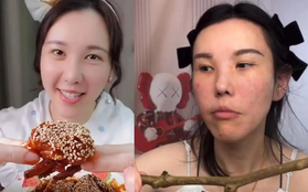 Mặt cô gái biến dạng nghiêm trọng sau 2 năm làm Mukbang