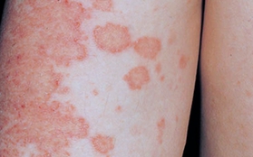 Tất cả về bệnh chàm khiến làn da đang đẹp cũng trở nên xấu xí