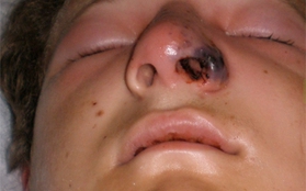 Kinh hãi cảnh vi khuẩn ăn thịt người tấn công mũi cậu thanh niên