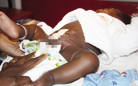 Namibia: Em bé có 4 chân đáng thương