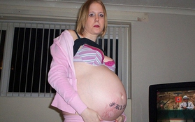 Không mang thai nhưng vẫn bị chẩn đoán sắp sinh vì bụng to vượt mặt
