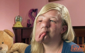 Cô gái trẻ có khuôn mặt "chảy" vì khối u lớn