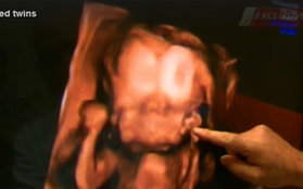 Em bé có 2 khuôn mặt, 2 não bộ cùng phát triển từ 1 hộp sọ
