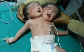 Bé gái 2 đầu đáng thương mới chào đời ở Ấn Độ