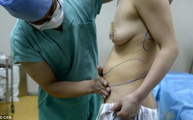 Bầu ngực nhân tạo di chuyển xuống  bụng và lưng sau ca phẫu thuật hỏng