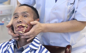 Lạ nhất tuần qua: Người đàn ông mọc răng ngoài miệng được phẫu thuật...