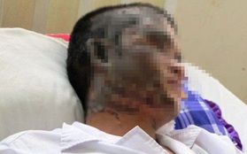 Thanh niên bị tạt axít vào mặt lúc đang ngủ ở Sài Gòn