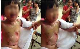 Bé gái 3 tuổi bị bỏng toàn thân ở trường mầm non