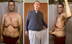 Người đàn ông có da bụng thừa chảy xệ như cao su sau khi giảm 177kg
