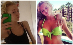 Teen girl suýt chết vì "cuồng" giảm cân 