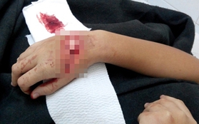 Đạp xe đi học, nữ sinh lớp 8 bị chém đứt gân tay