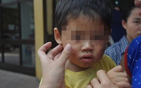 Bé 2 tuổi bị đánh gãy 4 cái răng, nhét băng vệ sinh vào miệng