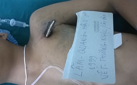 TP.HCM: Một học sinh ngã xuống ao, bị cọc đâm xuyên ngực
