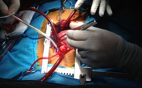 Phẫu thuật thành công cho bé trai 3 tuổi có tim nằm bên phải