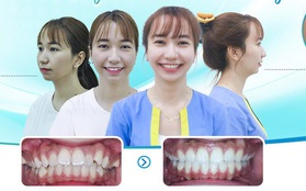 Nàng 9x đẹp bất ngờ sau hành trình giải thoát hàm răng hô