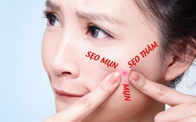 Tạm biệt sẹo thâm, nhận quà “sang chảnh”