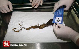 Trung Quốc: Choáng với bé gái có búi tóc dài 23cm trong bụng