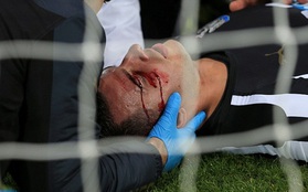 Va mặt vào cột dọc, cầu thủ Newcastle đổ máu trên sân