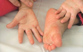 Chăm sóc trẻ bị tay chân miệng tại nhà: 5 việc quan trọng cần làm nhất để con nhanh khỏe