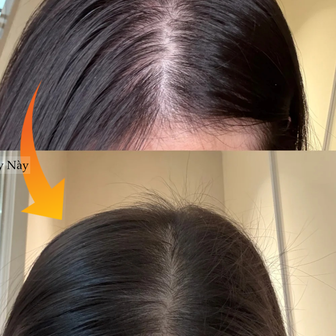 Tóc rụng đến nỗi lộ cả mảng da đầu, tôi quyết định theo 5 quy tắc chăm sóc sau để tóc đen dày trở lại