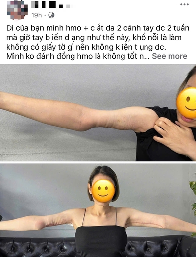 Netizen Việt sốc vì người phụ nữ có tay biến dạng sau hút mỡ, sự thật là gì?