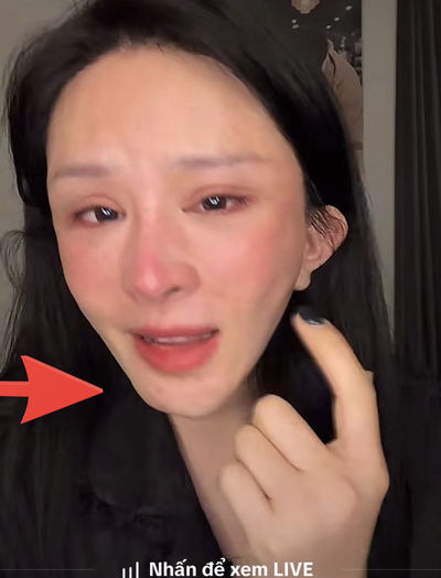 Xôn xao vụ cô gái hút mỡ hết 70 triệu nhận lại mặt biến dạng, nửa đêm "phốt" bác sĩ thẩm mỹ: Phía bác sĩ nói gì?