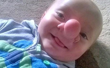 Cậu bé Pinocchio đời thực bị não tràn xuống mũi