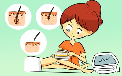 Cẩm nang giúp bạn tẩy lông bằng laser hiệu quả, an toàn