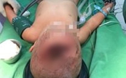 Nóng giận, cha dùng cốc uống nước ném con 18 tháng tuổi chấn thương sọ não