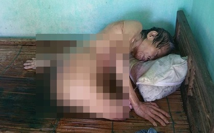 Cộng đồng kêu gọi giúp đỡ cụ bà mù, cụt chân đang thoi thóp vì vết thương lở loét