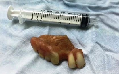 Thanh niên 26 tuổi nuốt răng giả vào bụng sau tiệc cưới