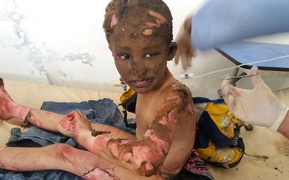 "Đây là Syria, không phải Việt Nam" - Loạt ảnh xé lòng về những đứa trẻ bị thiêu đốt trong trận không kích bằng napalm