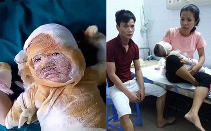 Mẹ sơ sẩy, con trai 11 tháng tuổi bị ấm nước siêu tốc đổ xuống đầu, bỏng nặng toàn thân