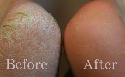 Đến kem trị nẻ cũng phải “chào thua” phương pháp làm hồng gót chân từ vỏ chanh này