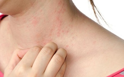 Những bệnh dị ứng hay gặp nhất vào mùa hè và cách xử lý