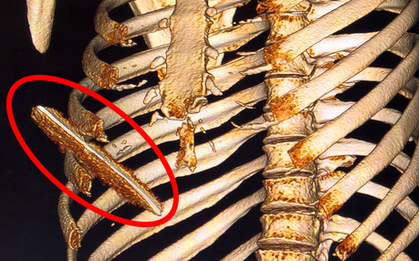 Thanh niên bị lưỡi dao 10 cm đâm lút ngực, thủng gan vẫn may mắn thoát chết