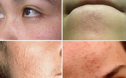 Nếu không biết những điều sau, mụn ẩn có thể bám theo bạn suốt đời