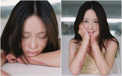 Bộ ảnh tuyệt đẹp của cô gái trẻ từng bị bạn học tẩm xăng đốt vì mâu thuẫn tình cảm