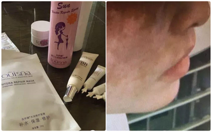 Liều mình mua mỹ phẩm "thần thánh" không rõ nguồn gốc, da mặt trở nên loang lổ đáng sợ
