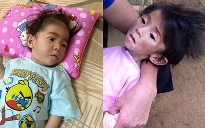 Sau 1 tháng, bé gái 14 tháng từng chỉ nặng 3,5kg đã được "hồi sinh" thế này...
