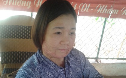 Kí ức kinh hoàng của người phụ nữ bị người yêu thiêu sống