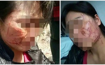 Vợ bị chồng và nhân tình dùng vật sắc nhọn rạch hơn trăm phát vào mặt
