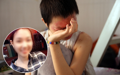 Nữ sinh từng bị tạt axit chấn động Sài Gòn: "Em vẫn không hiểu mình đã làm gì sai..."