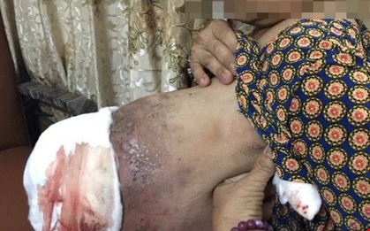 Suýt bị hoại tử vú vì đắp thuốc nam