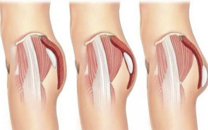 Vòng 3 ngày càng xẹp lép và chảy xệ chỉ vì 4 thói quen nhiều người mắc phải