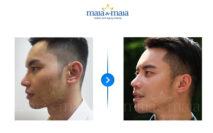 Lời giải cho 1001 lời cầu cứu trị thâm mụn