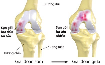 6 căn bệnh nguy hiểm mà người thừa cân, béo phì có nguy cơ cao mắc phải