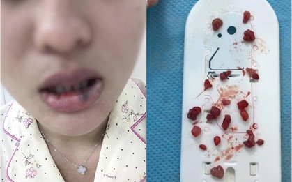 Hà Nội: Bơm môi hình trái tim, cô gái trẻ hoảng hồn khi phát hiện 18 "dị vật" như viên bi bên trong môi