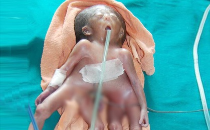 Cuộc sống ngắn ngủi của bé gái chỉ có một đầu nhưng dính liền với hai thân tách biệt
