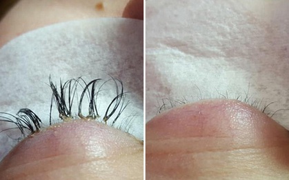 Đi nối mi tại chỗ không có tâm, cô gái trẻ bị rụng sạch mi thật lại còn nhiễm trùng mí mắt